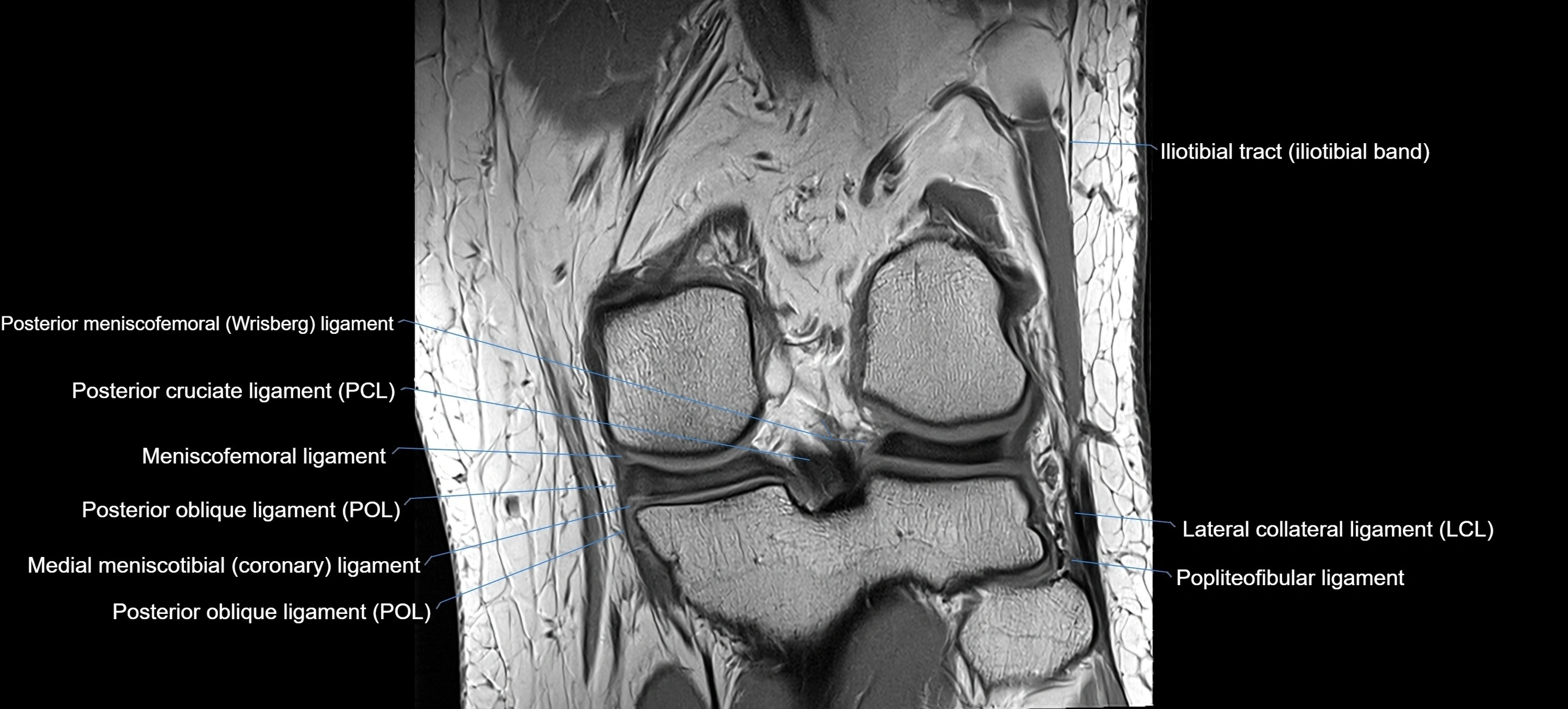 MRI coronal  ligaments cross sectional anatomy 3T  radiology  image-img-04001-00026.webp